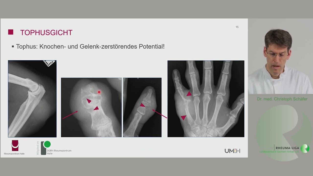 Kurzvorstellung der Gicht, ihrer Ursachen und Behandlung für Patienten.