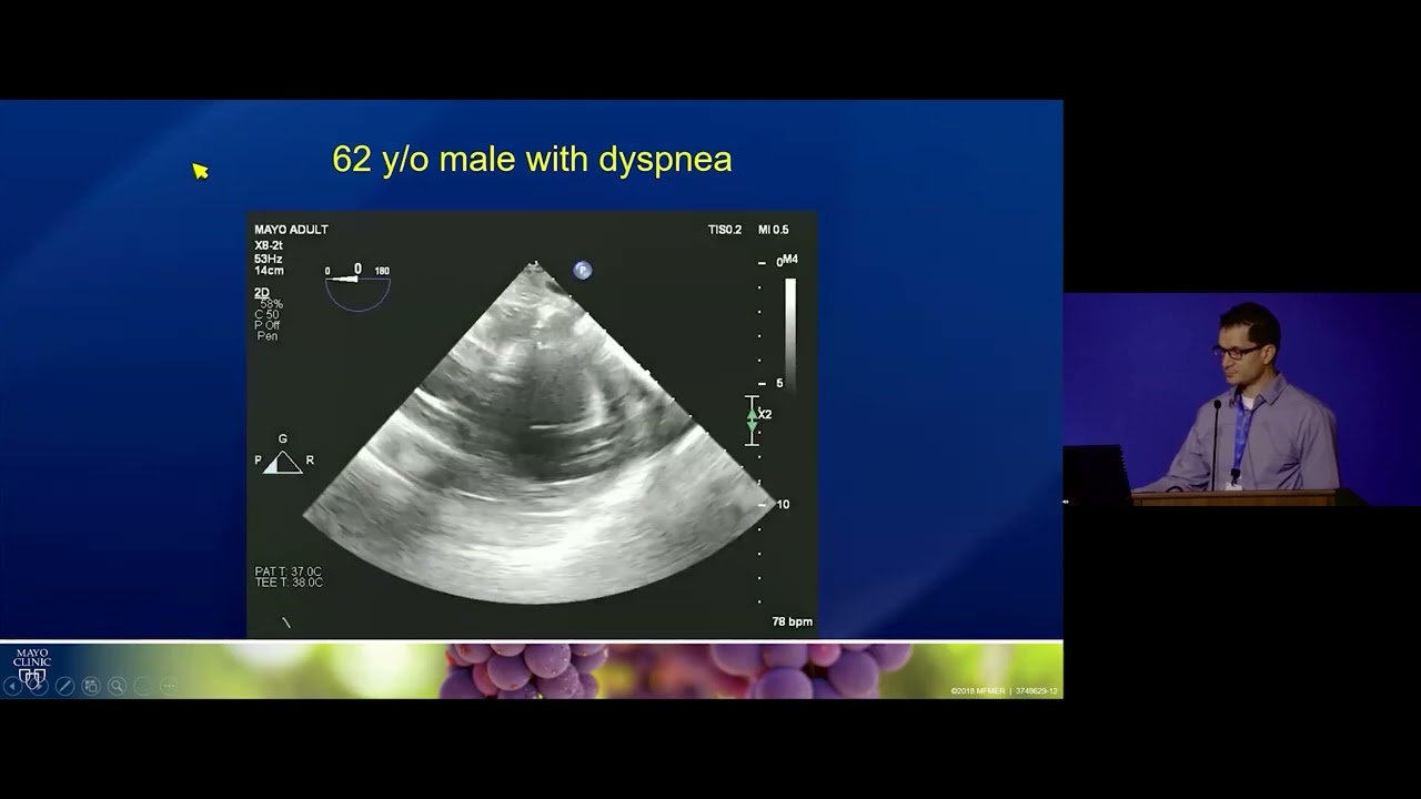 Aortic and Mitral Bioprosthesis Dysfunction with Hemolysis