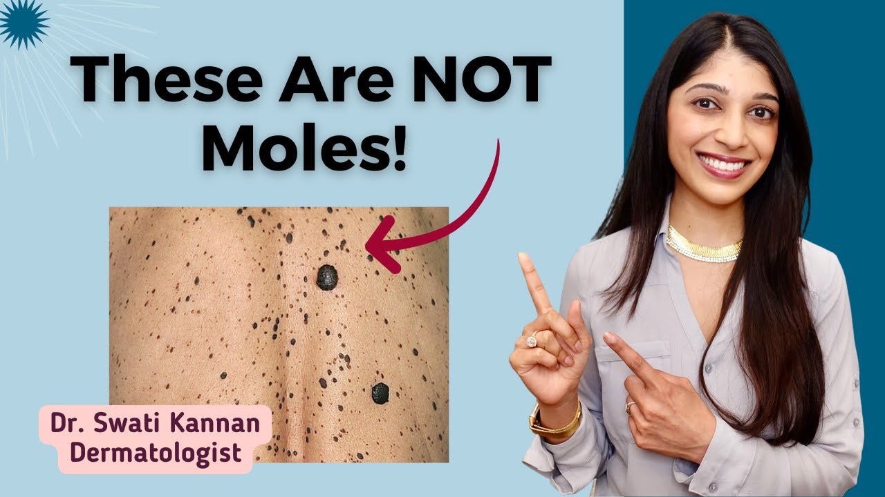Mystery Skin Spots? What You Need to Know About Seborrheic Keratoses