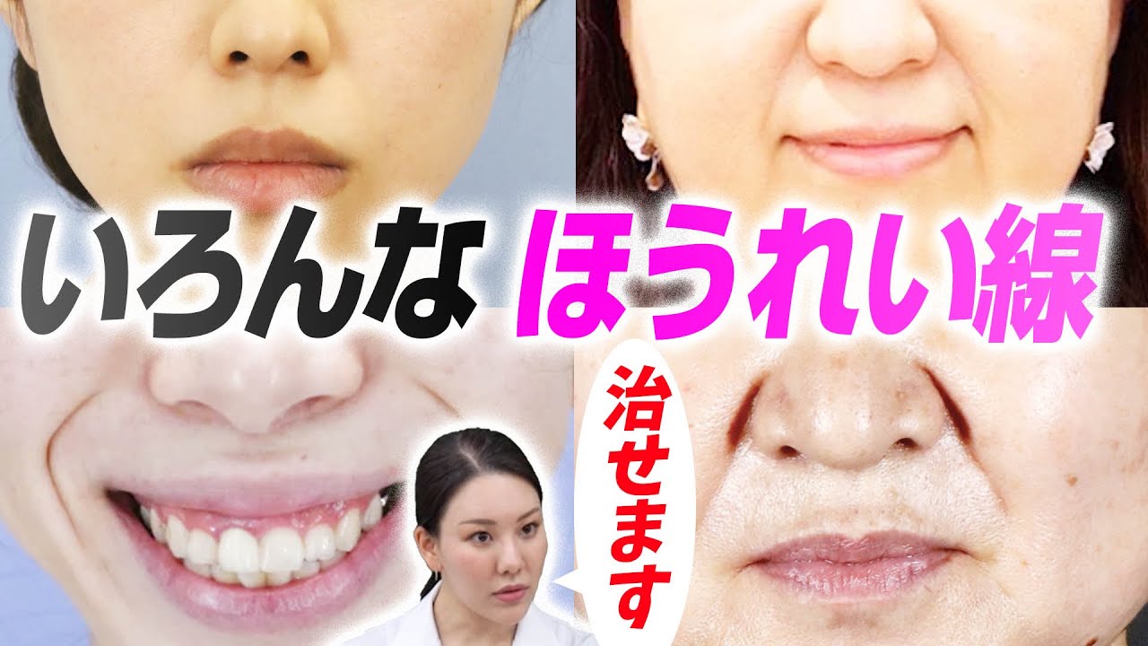 【あなたは大丈夫？】ほうれい線のタイプ別治療法お教えします！