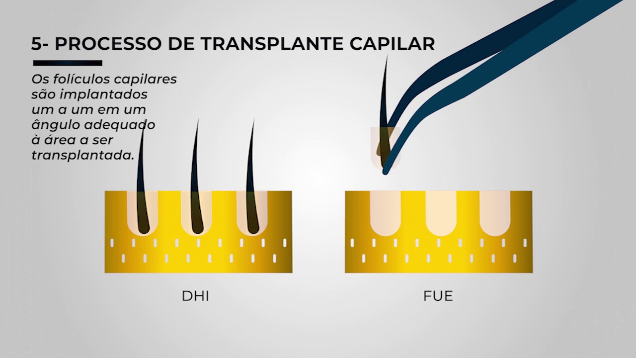 Transplante Capilar