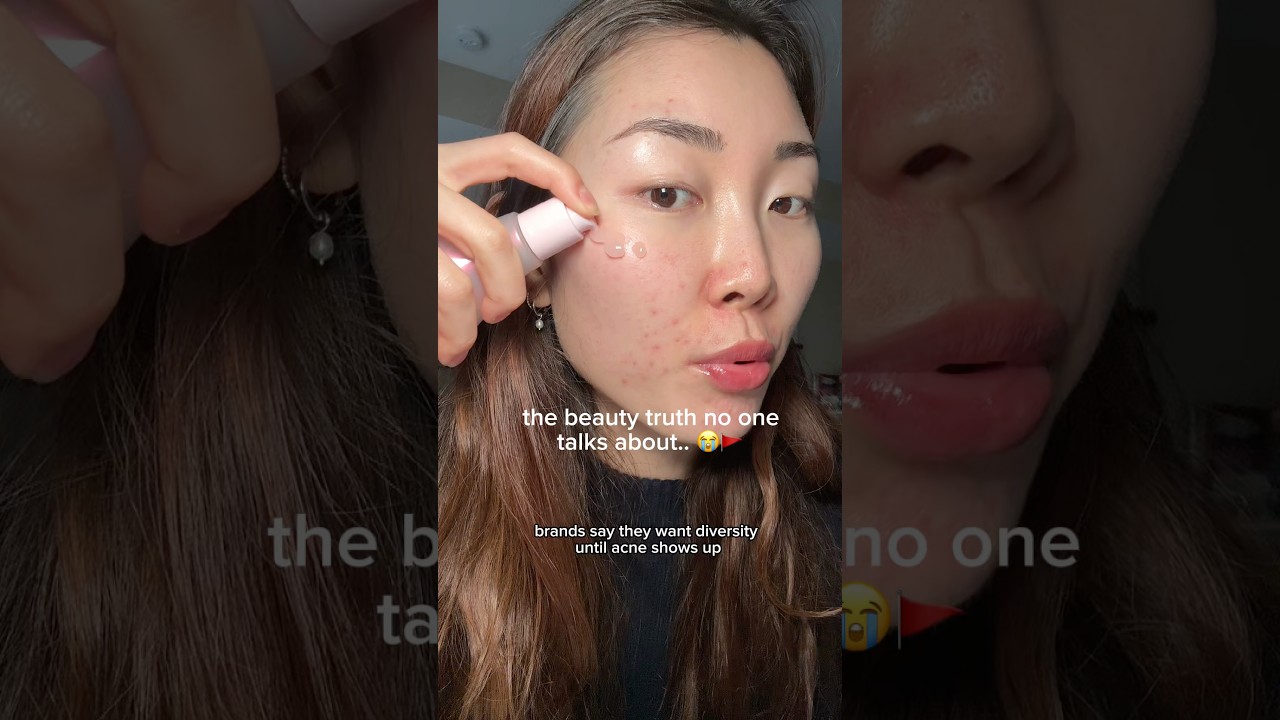 BRANDS HATE ACNE SKIN.. 😭🚩 #acne #acneproneskin #modeling