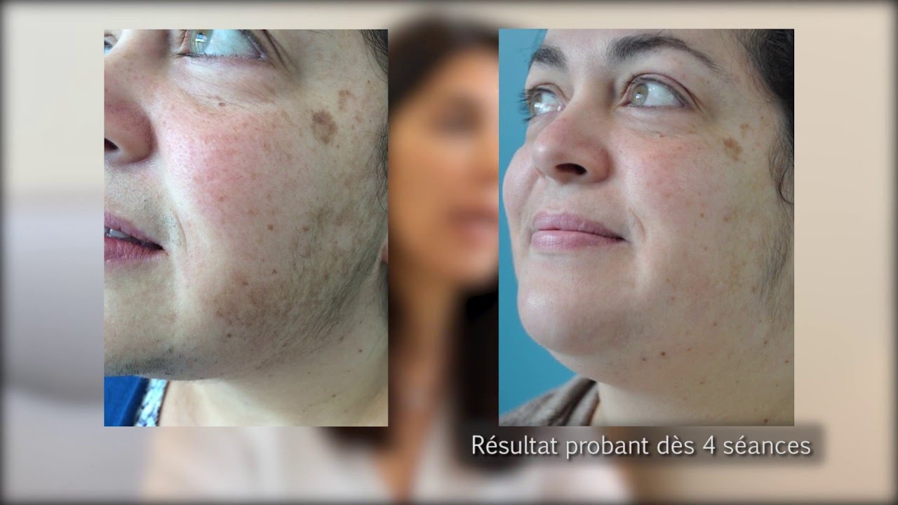Epilation du visage avec lasers dermatologiques par le Dr Phryné COUTANT-FOULC à Nantes 44.