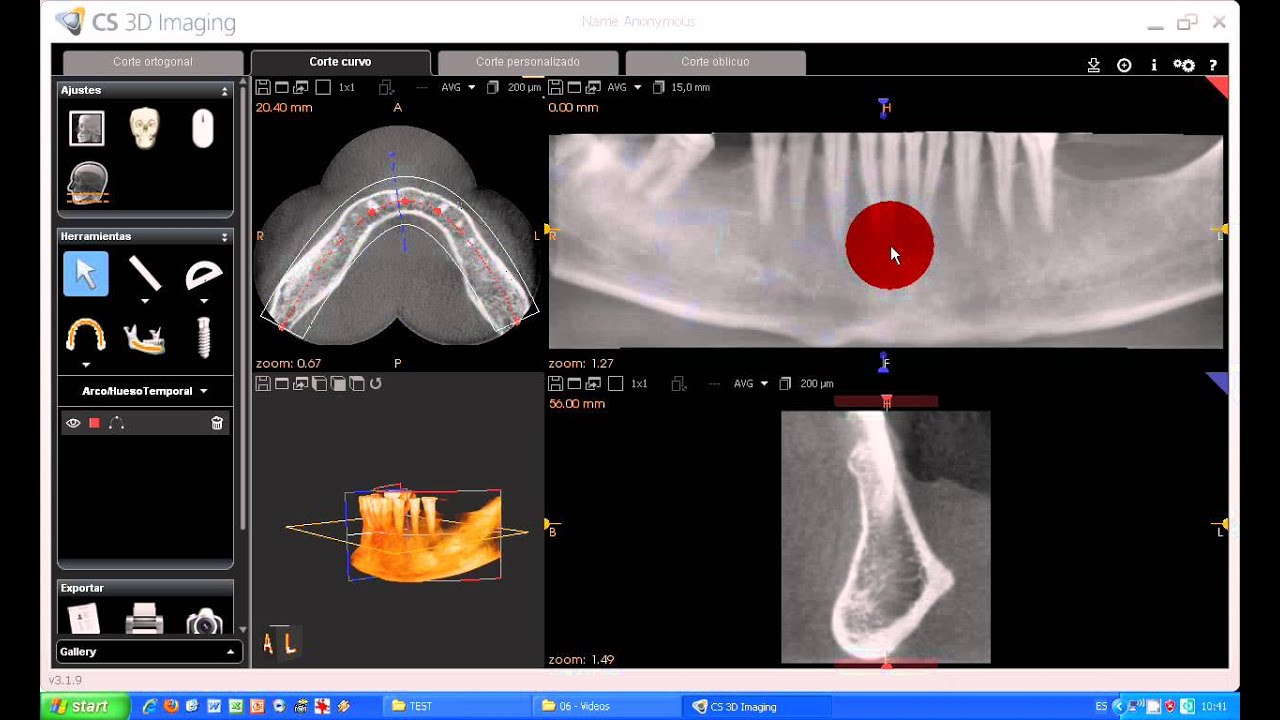 Tutorial CS 3D imaging software. 06-Carestream. Corte Curvo & Arcada Dental.avi