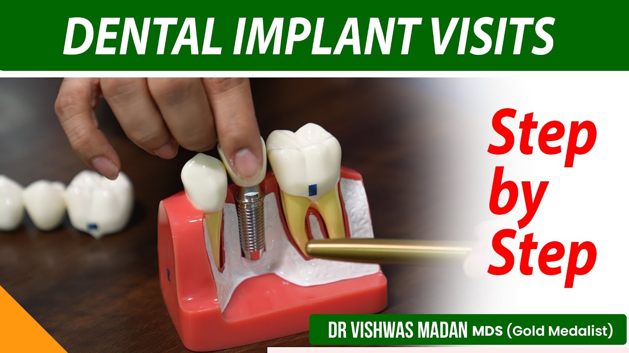 Dental Implants Procedure | Dental Implant cost in India #dentistry #dentistryworld