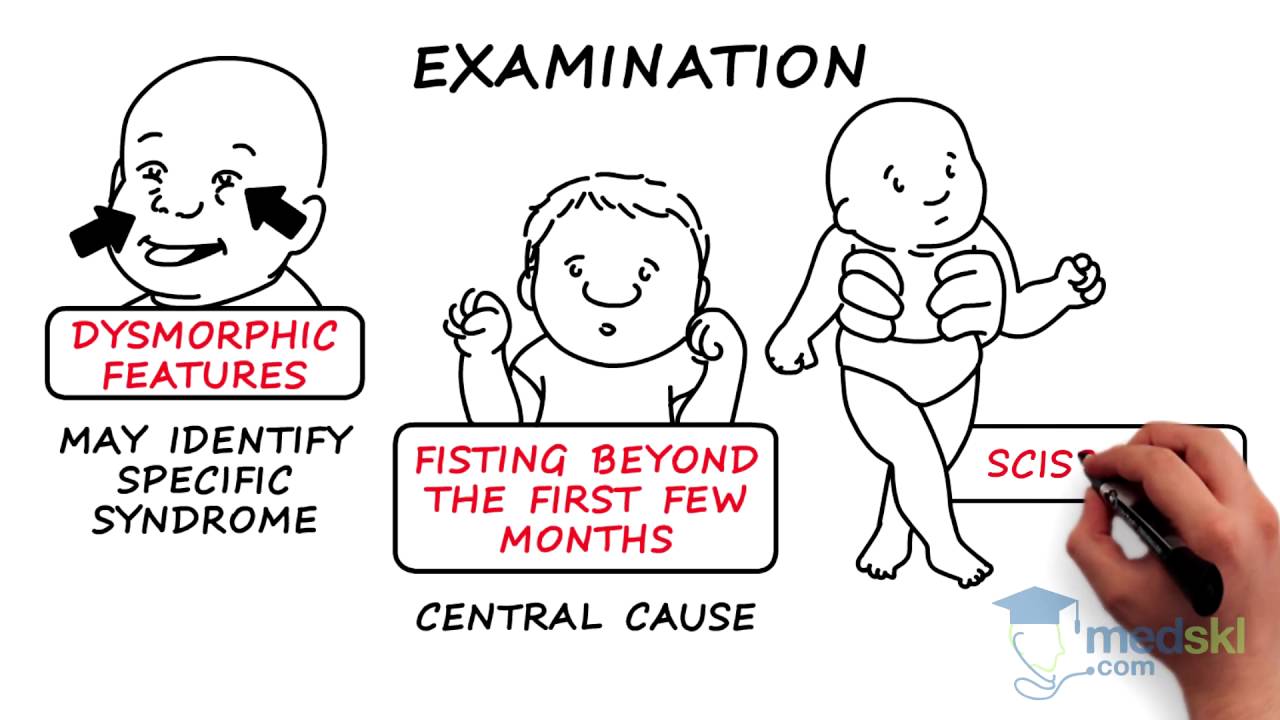 Pediatrics – Hypotonic Infant: By Wendy Stewart M.D.