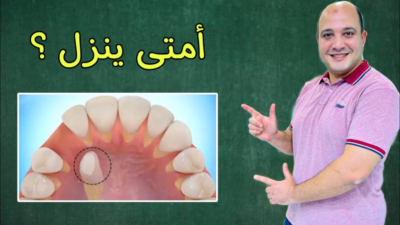 تقويم الناب المدفون؟ #دكتور_اسلام_نبيل #تقويم_اسنان