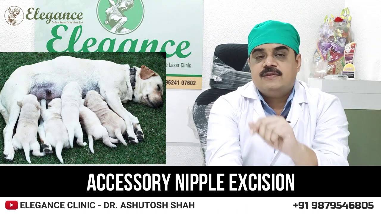 Accessory Nipple Excision, Breast Surgery By Dr. Ashutosh Shah, Elegance Clinic Surat, Mumbai, Pune.