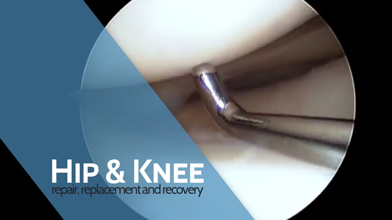 The Procedure | Arthroscopy