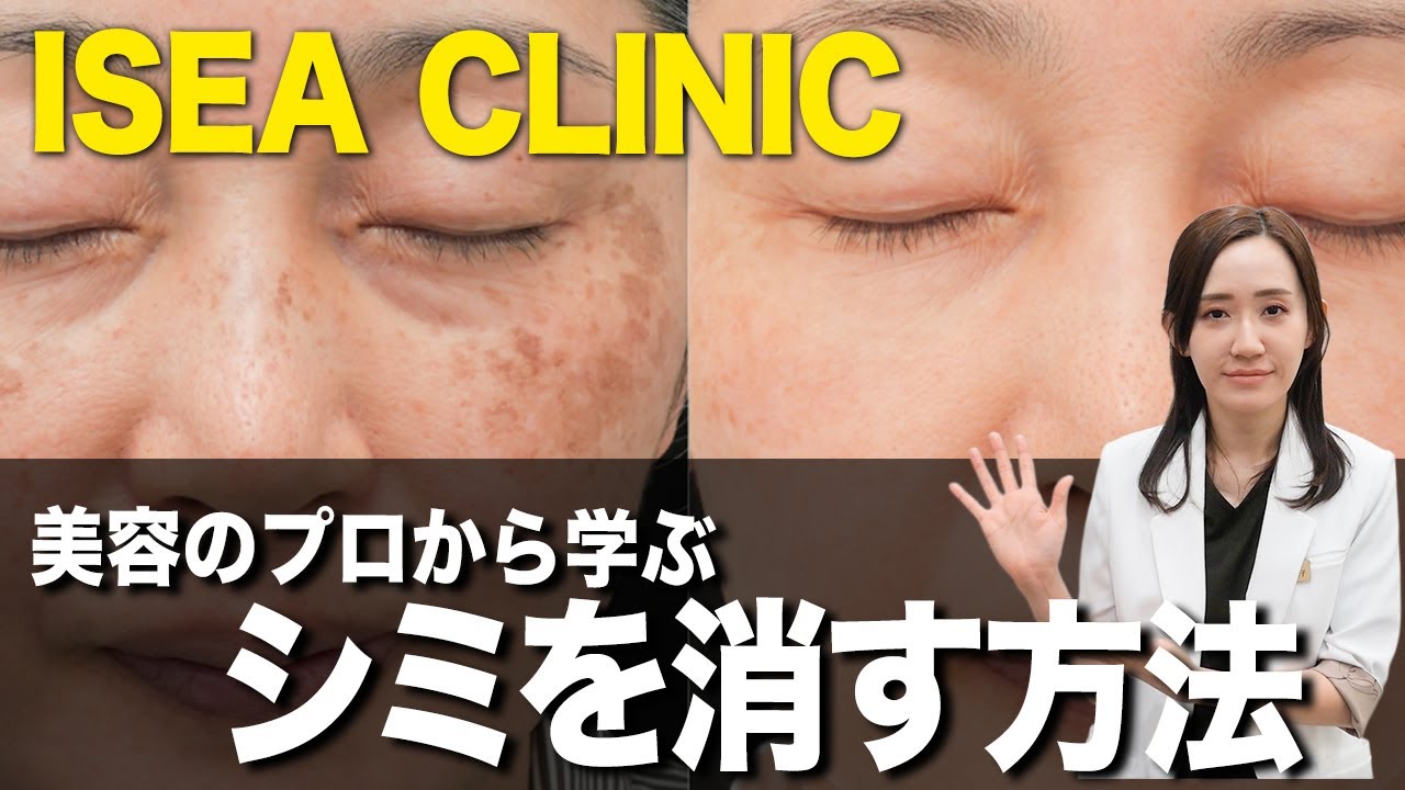 シミって結局消せるのか…これだけおさえておけ。