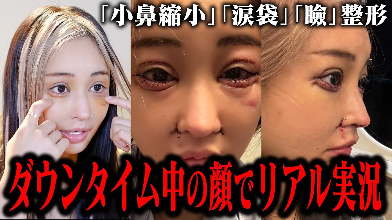 【激しくやりました】メンテナンスも含めて今回の整形ポイントをお話します。