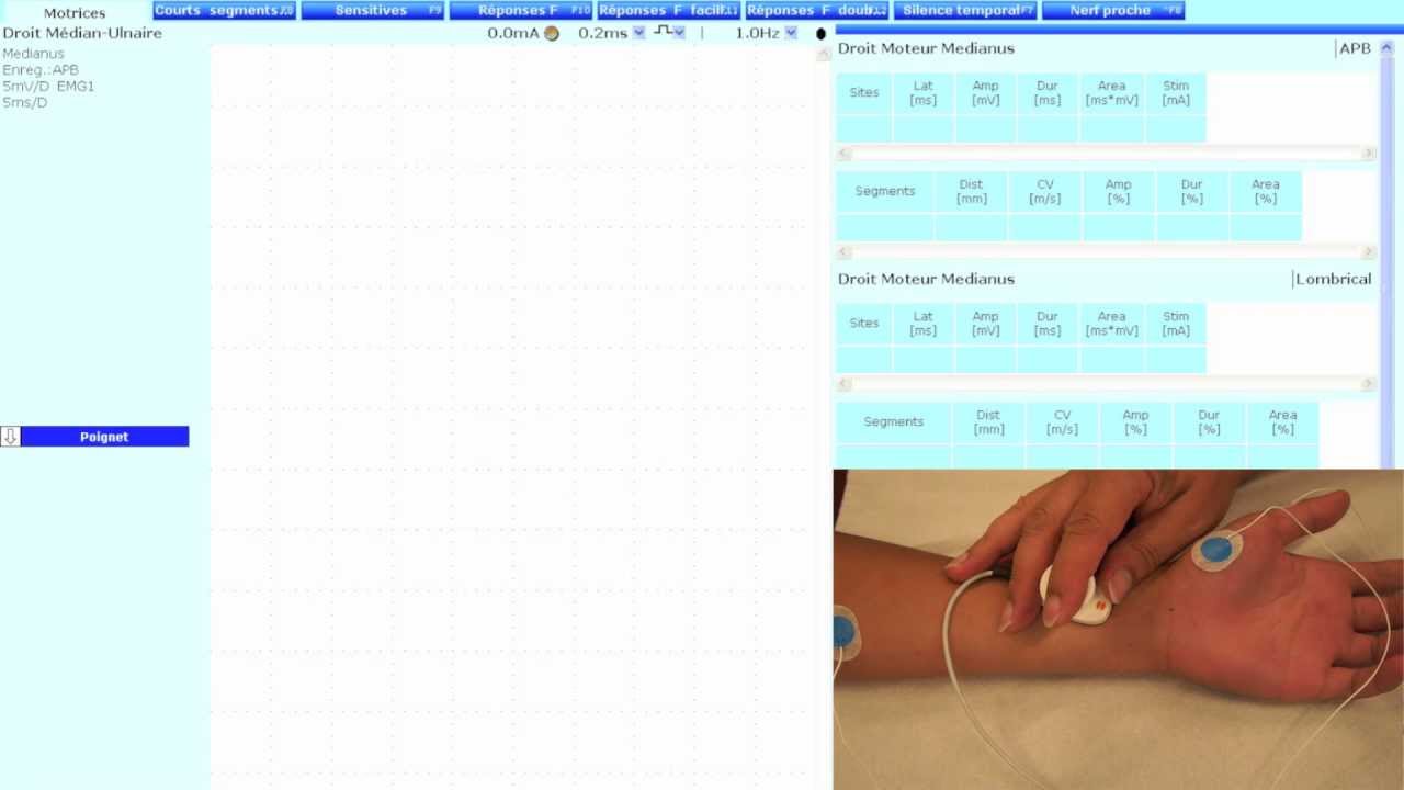 Nerf m&eacute;dian (neurographie motrice : r&eacute;ponses M et F)