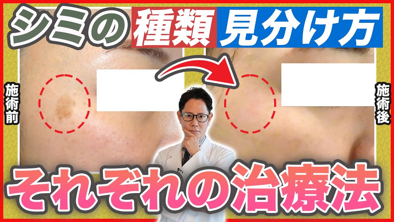 【シミ・肝斑治療】どう治す？しみの種類や見分け方と消す方法を解説
