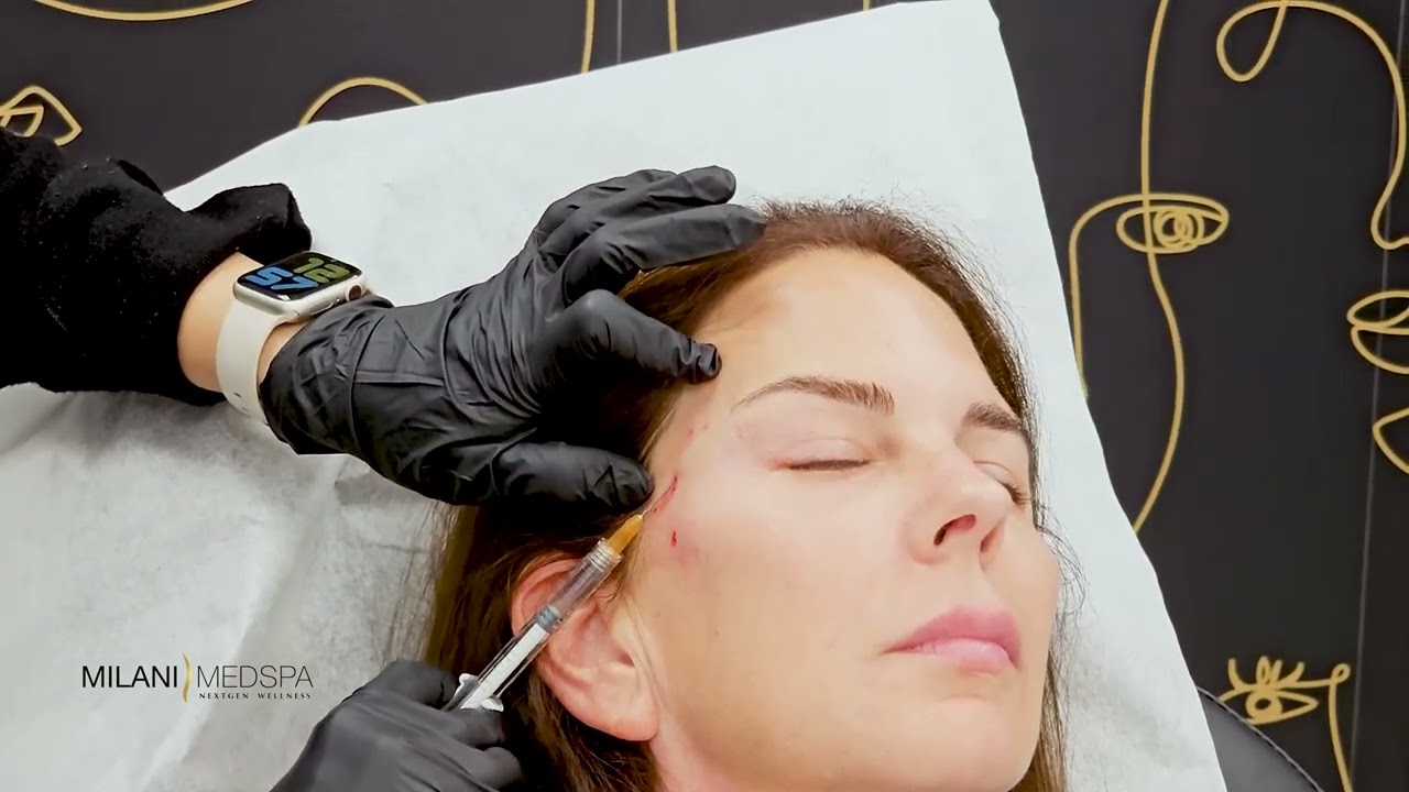Loss of Volume in the Temples? Filler can help restore and enhance facial contours.