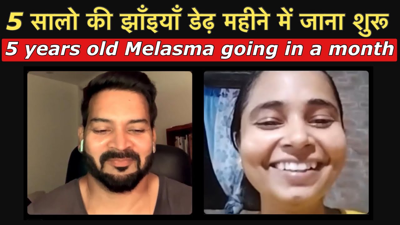 5 सालो की झाँइयाँ डेढ़ महीने में जाना शुरू 😎 My 5 years old Melasma is going in a month