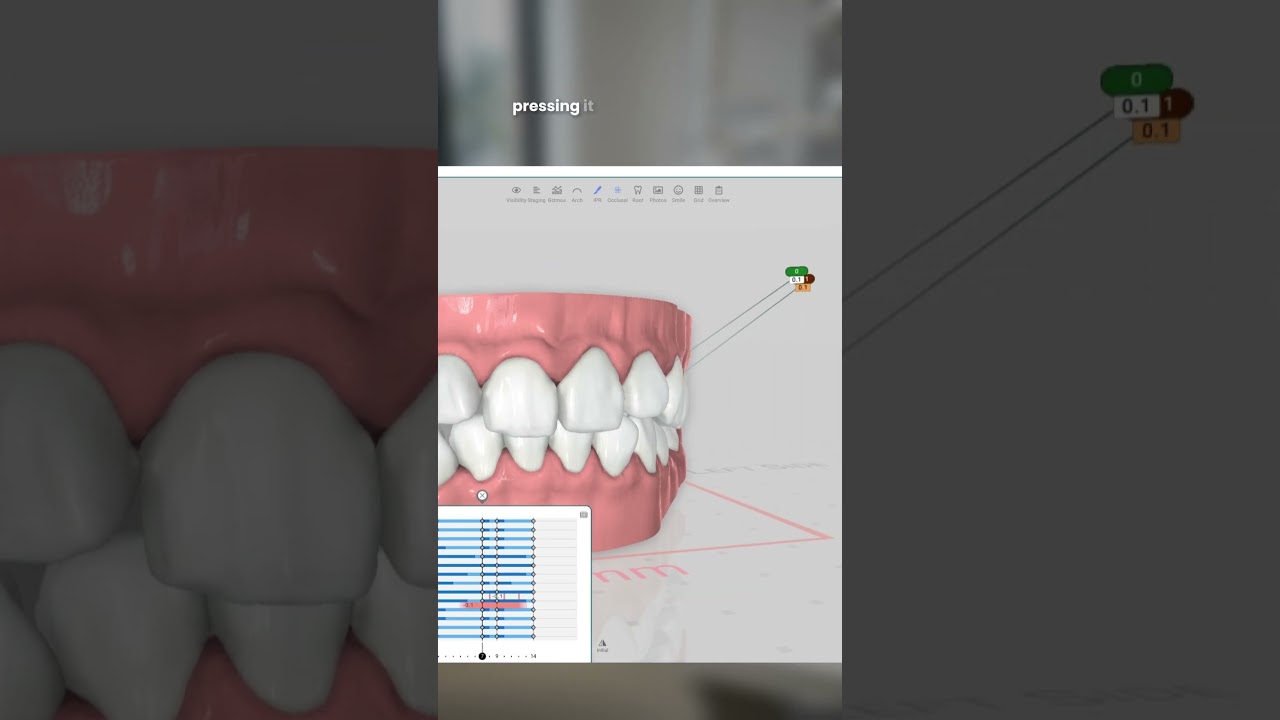 3 Ways to Fix Mid Treatment Collisions in Titan Dental Design
