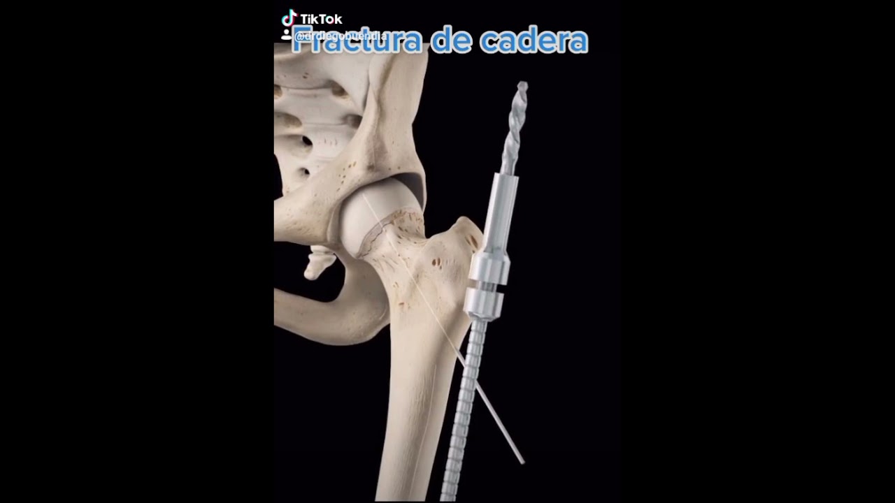 Fractura de cadera 😰 &iexcl;as&iacute; la reparamos!