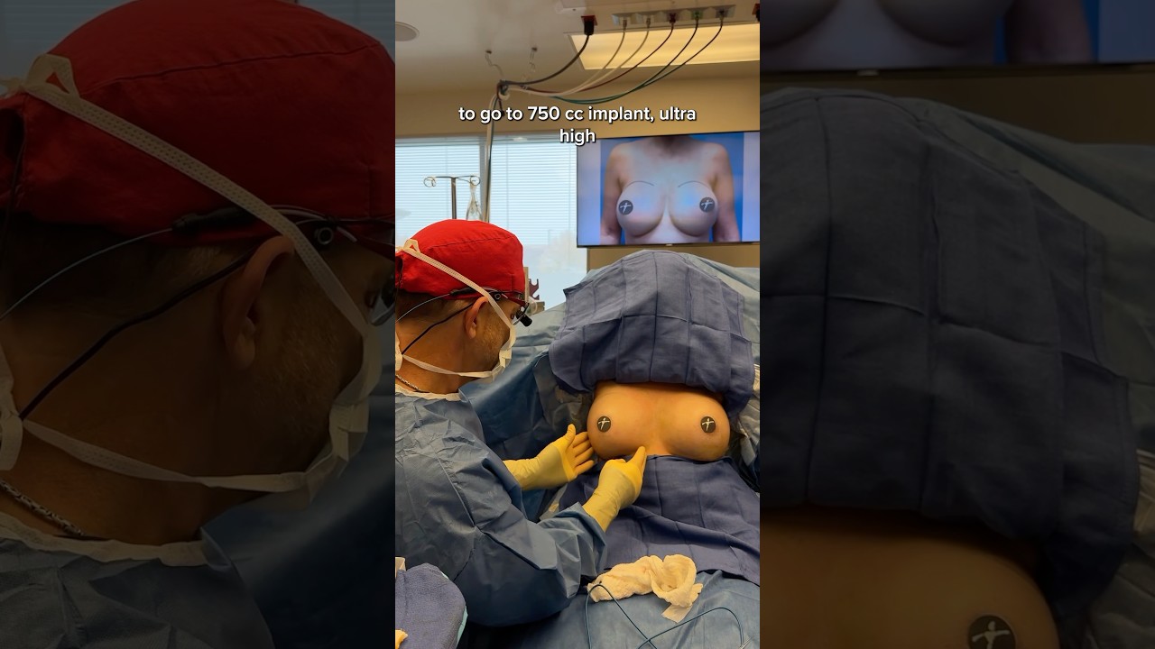 Breast implant removal & replacement! Upsizing from 550cc&rsquo;s to 750cc&rsquo;s. 🍒