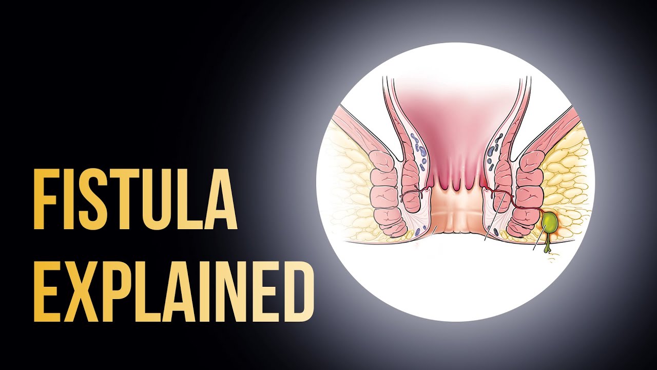 #ApolloHospitals |  Fistula Treatment, Causes & Symptoms Explained