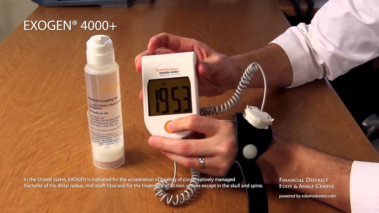 EXOGEN&reg;  Bone Healing System - FDFAC - San Francisco - Sports Medicine - Fractures