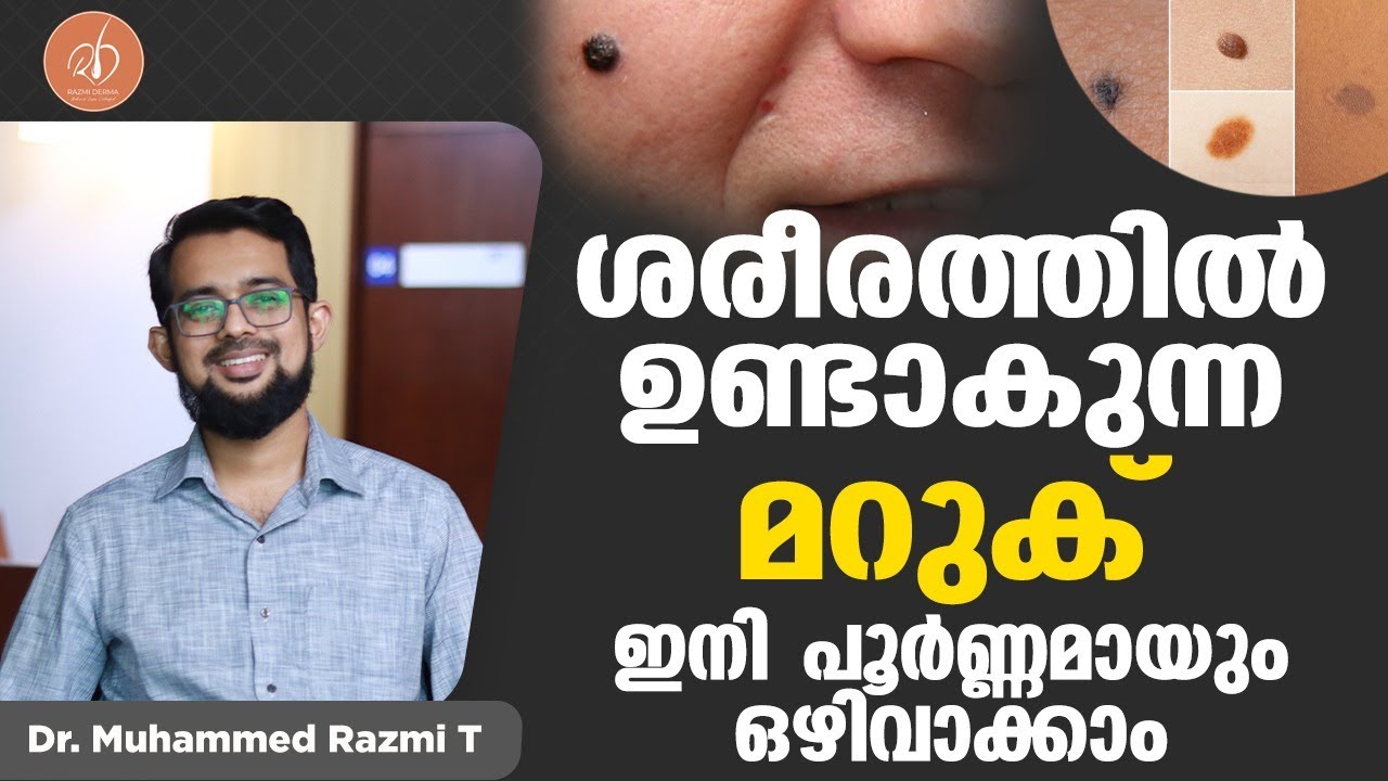 ശരീരത്തിൽ ഉണ്ടാകുന്ന മറുക് ഇനി പൂർണ്ണമായും ഒഴിവാക്കാം | Maruk | Mole | Malayalam | Dr Muhammed Razmi