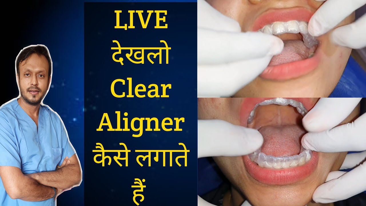 Clear Aligners कैसे लगाते हैं आज देखलो Live Patient में | Aligners duration ?