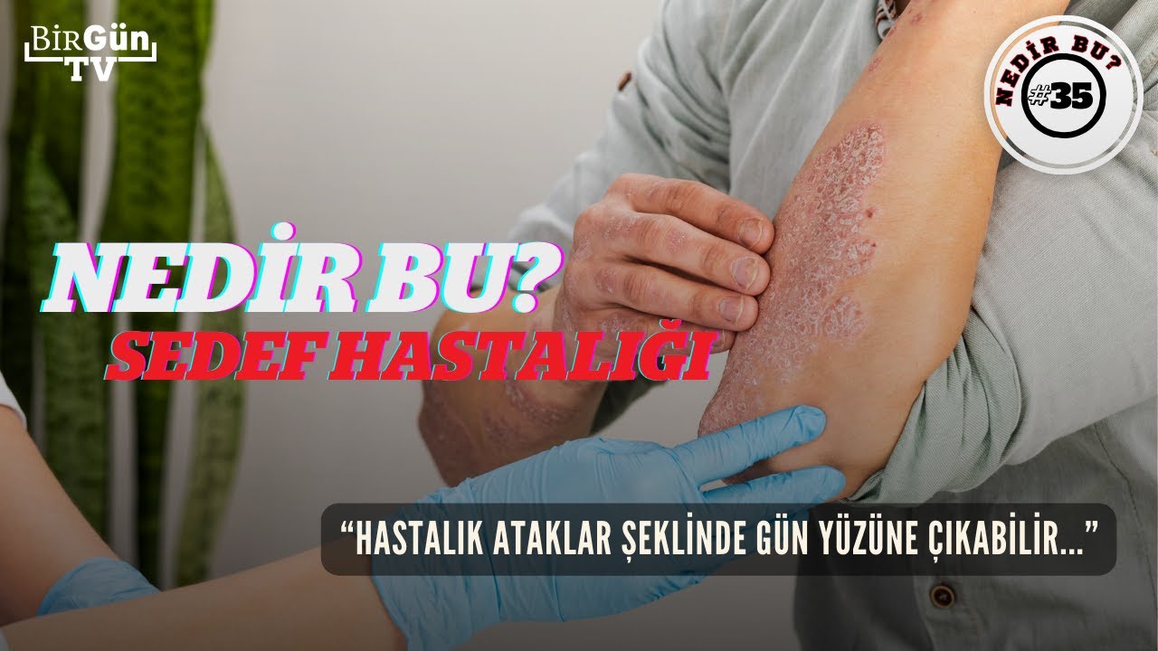 Nedir bu: Sedef hastalığı? Belirtileri neler? Türleri neler? Bulaşıcı mı? 
