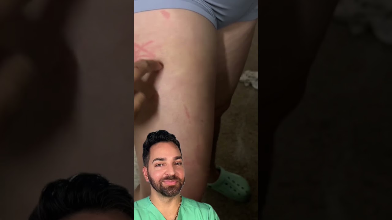 Co to jest? Doktor wyjaśnia dermatografię #kr&oacute;tkie