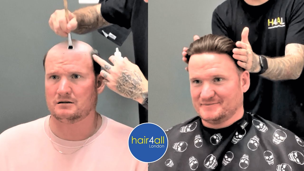 Before & After | Hair System | Non-Surgical Hair Replacement System Men/Women | UK/USA/International