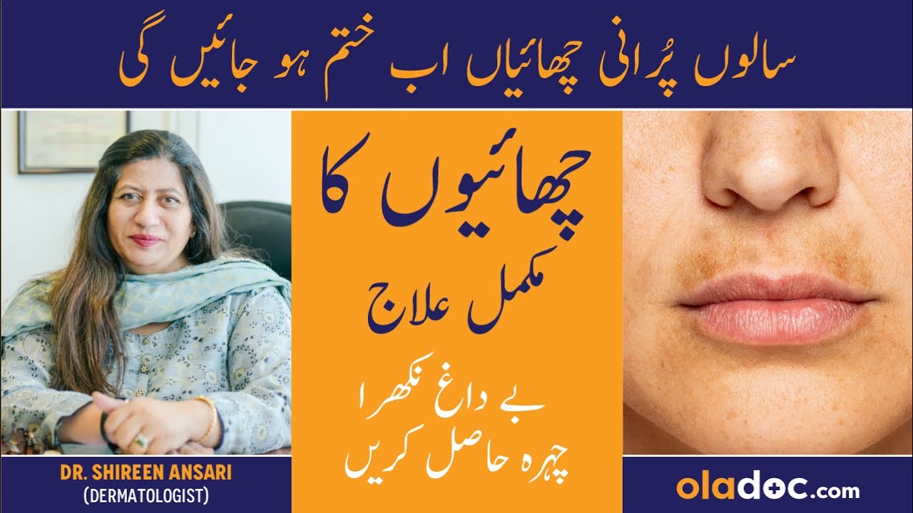 GET RID OF PIGMENTATION - Chaiyan Khatam Karne Ka Tarika - Melasma Aur Pigmentation Ka Ilaj