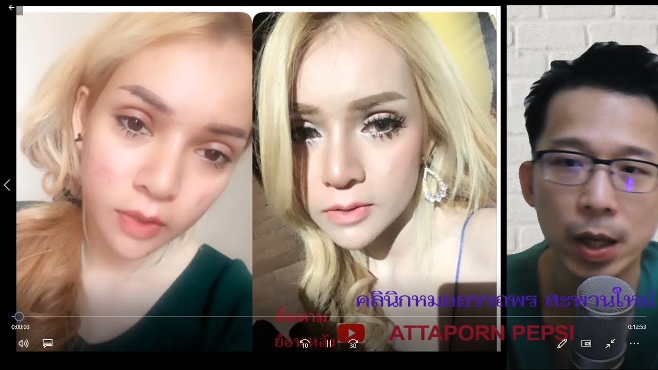 รีวิวตาสองชั้น ชั้นตาสูง ที่เรียกว่าชั้นตาสายฝ. อรรถพรคลินิก โดยเฉพาะทางศัลยแพทย์ตกแต่ง