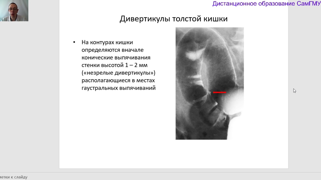 Классическая рентгенологическая диагностика заболеваний толстой кишки. Лектор Бурмистров М.А.