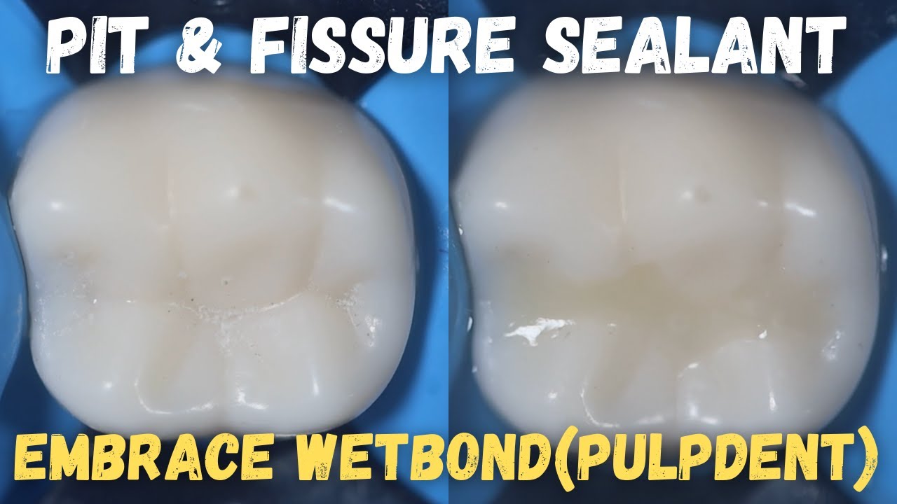 Pit & Fissure Sealant 🟢 Embrace WETBOND from PULPDENT ⚪️ Simulated demonstration