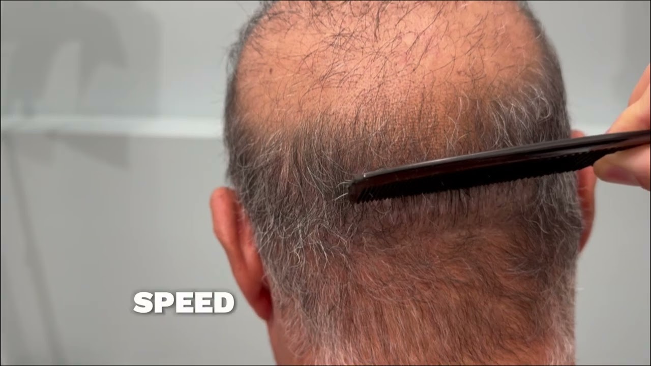 FUE Hair Transplant Into Thick Wide Scar Tissue - Dr. Sean Behnam