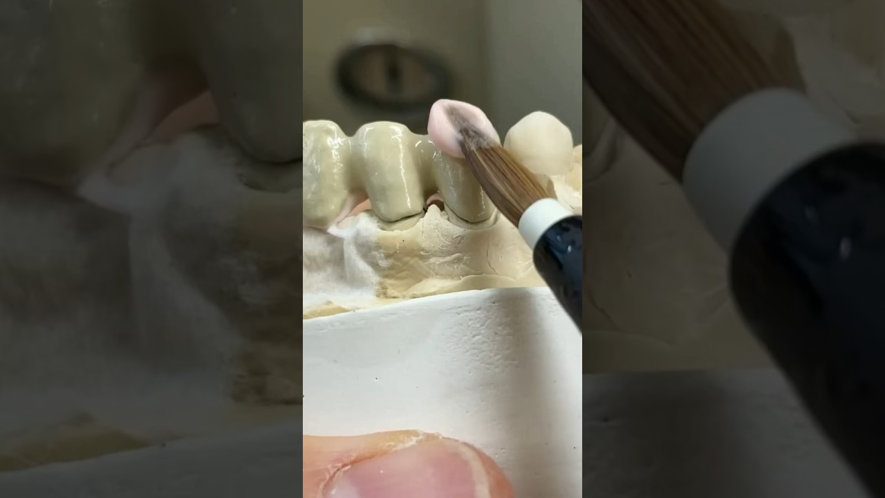 Przednia odbudowa porcelanowa