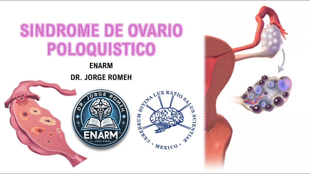 SINDROME DE OVARIO POLIQUISTICO (SOP) - ENARM - TODO LO QUE DEBES SABER
