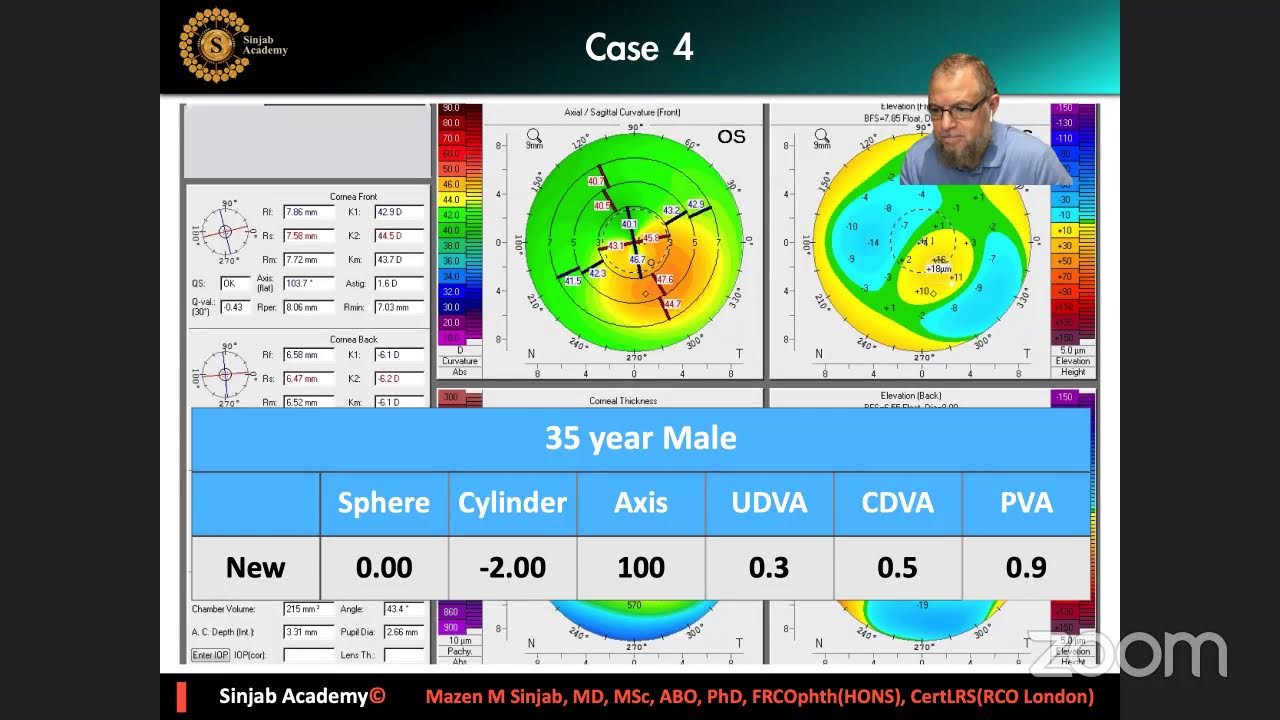 Corena - To The Wonderland -  Keratoconus Decision Making - Mazen Sinjab
