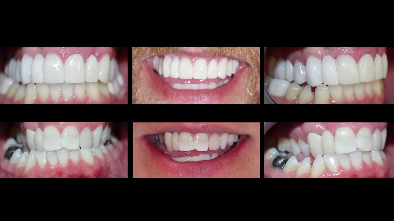 Invisalign and Dental Crowns Before and After Images at Cosmetic Dental Associates San Antonio, TX