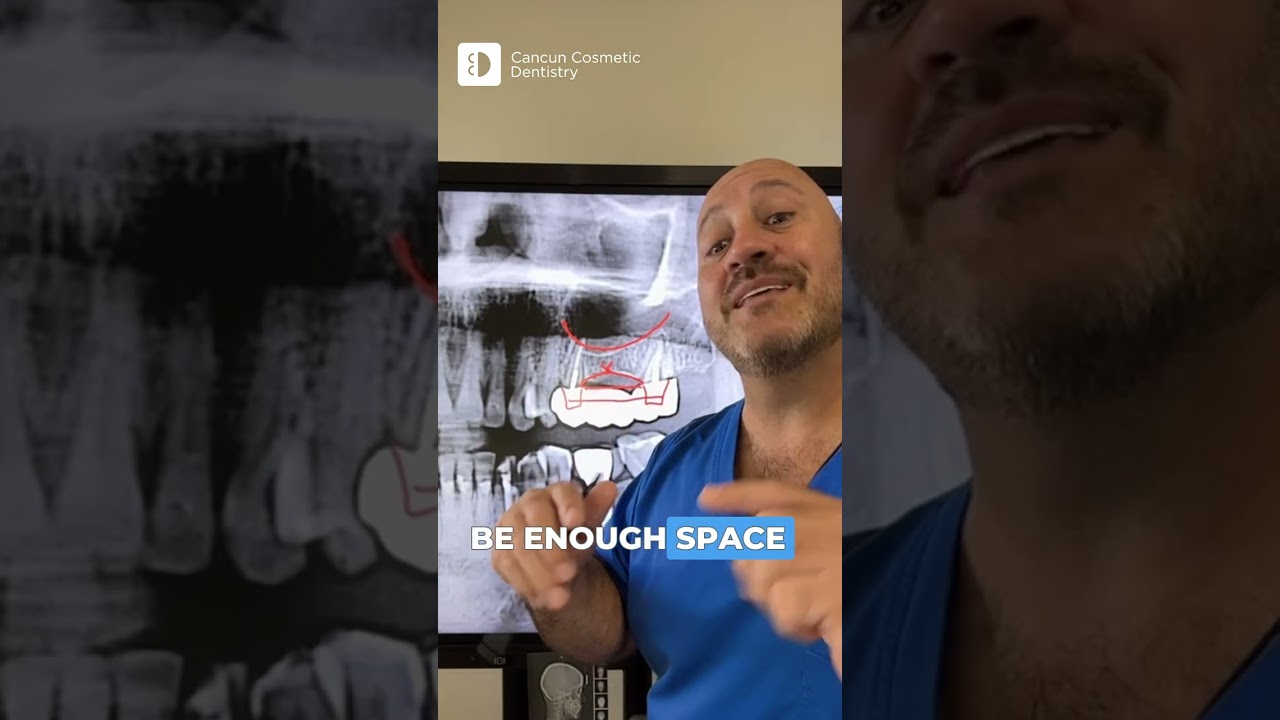 🦷 Bridge vs. Implant &mdash; What&rsquo;s REALLY Best for Your Smile? 🤔