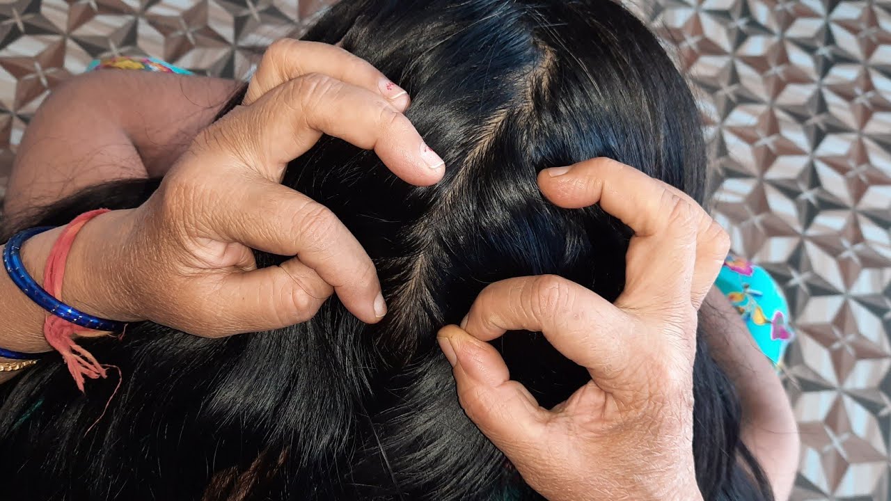TRADITIONAL NITPICKING LICE EGGS | HEAD LICE NITPICKING LONG HAIR | ASMR NIT PICKING LOTS OF LICE
