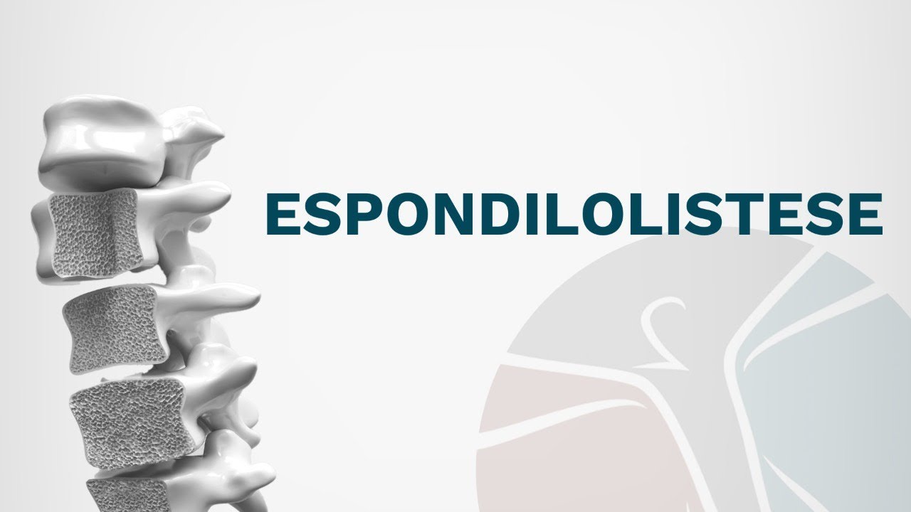 Espondilolistese