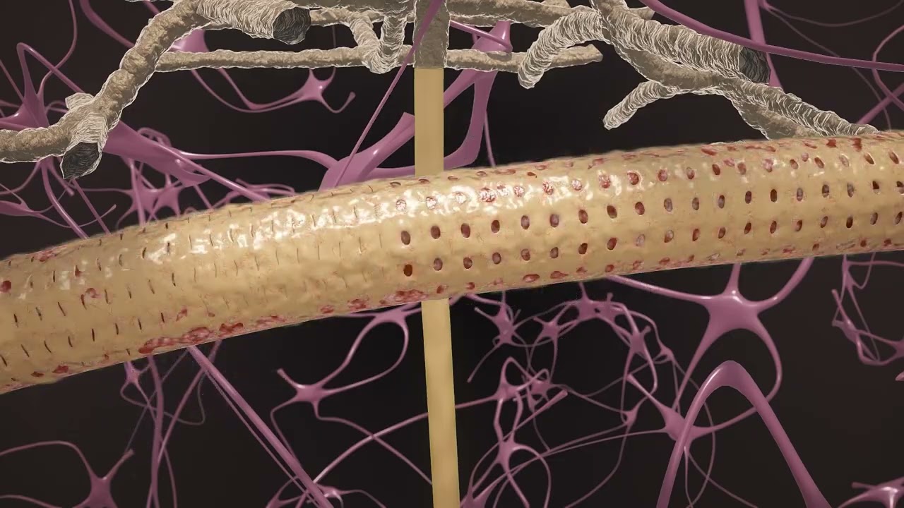Coronavirus Brain Damage: Two Ways COVID-19 Can Cause Long COVID