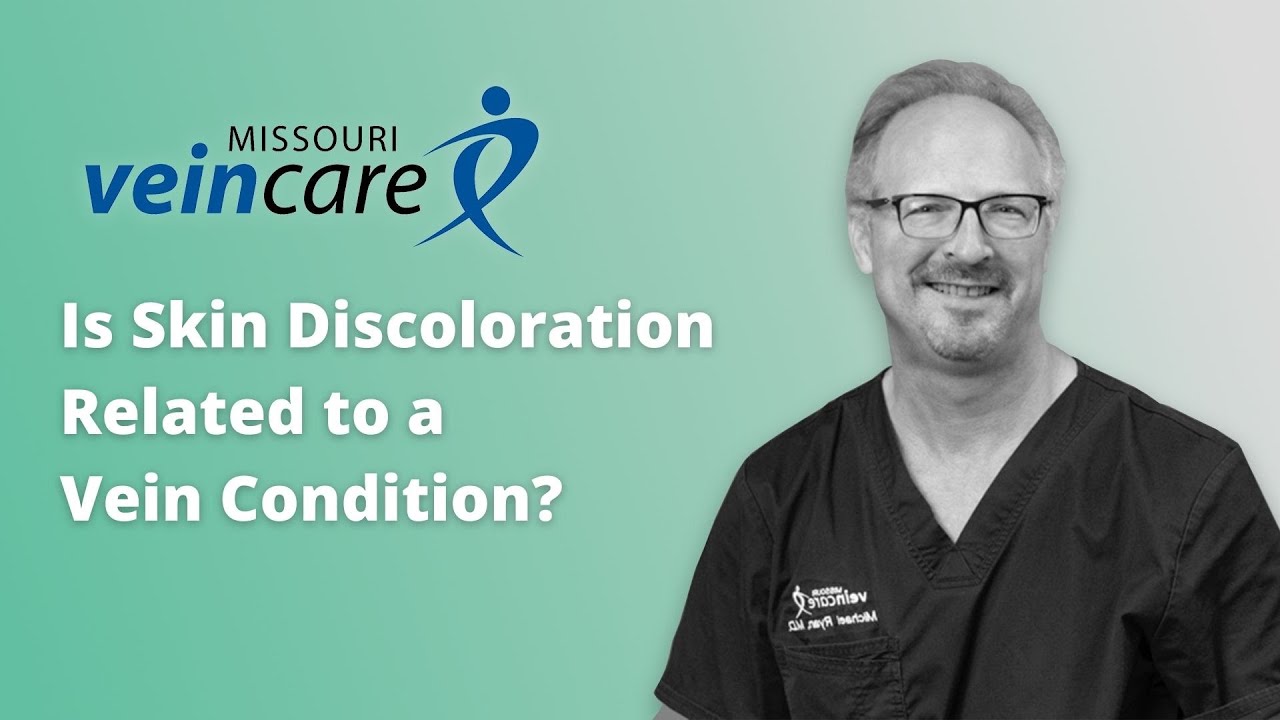 Is Skin Discoloration Related to a Vein Condition?