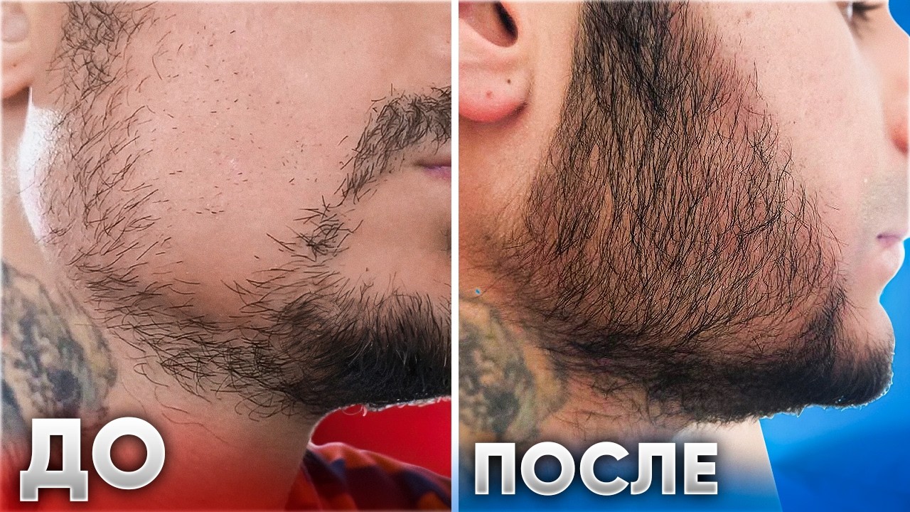 Зарастил щеки густой бородой! Mr.Volos — результаты за 5 мес