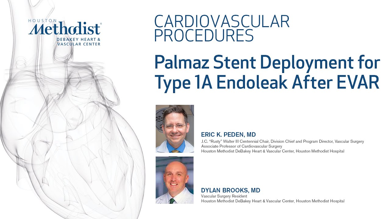 Palmaz Stent Deployment for Type 1A Endoleak After EVAR (Dylan Brooks MD, Eric Peden MD)