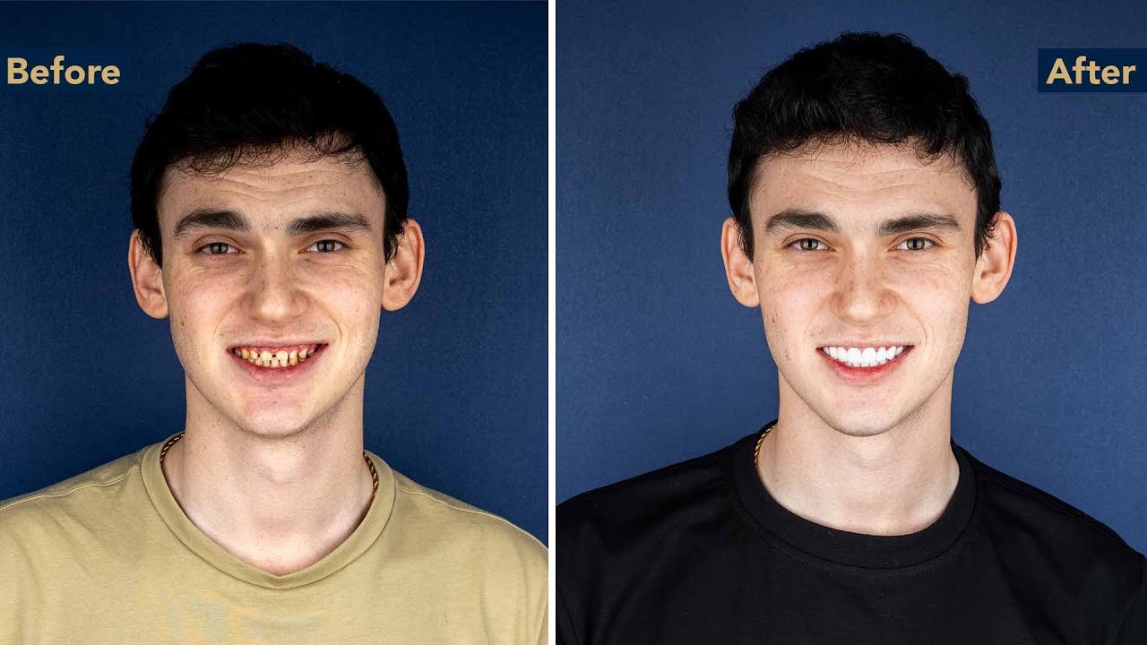 Full Smile Transformation in Turkey | Jake’s Experience at Kristal Clinic (Los Angeles → Istanbul)