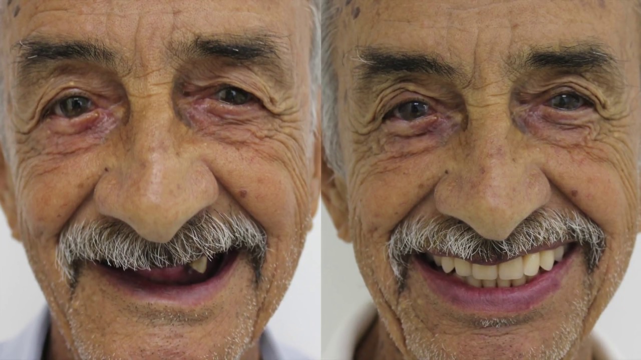 Implante Dent&aacute;rio Sem Dor com LASER - Volte a Sorrir de Novo!