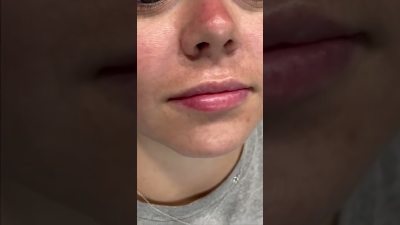 1ml of Filler Makes a HUGE Difference! in Beverly Hills Wellness Center & Med Spa, Palm Beach, FL