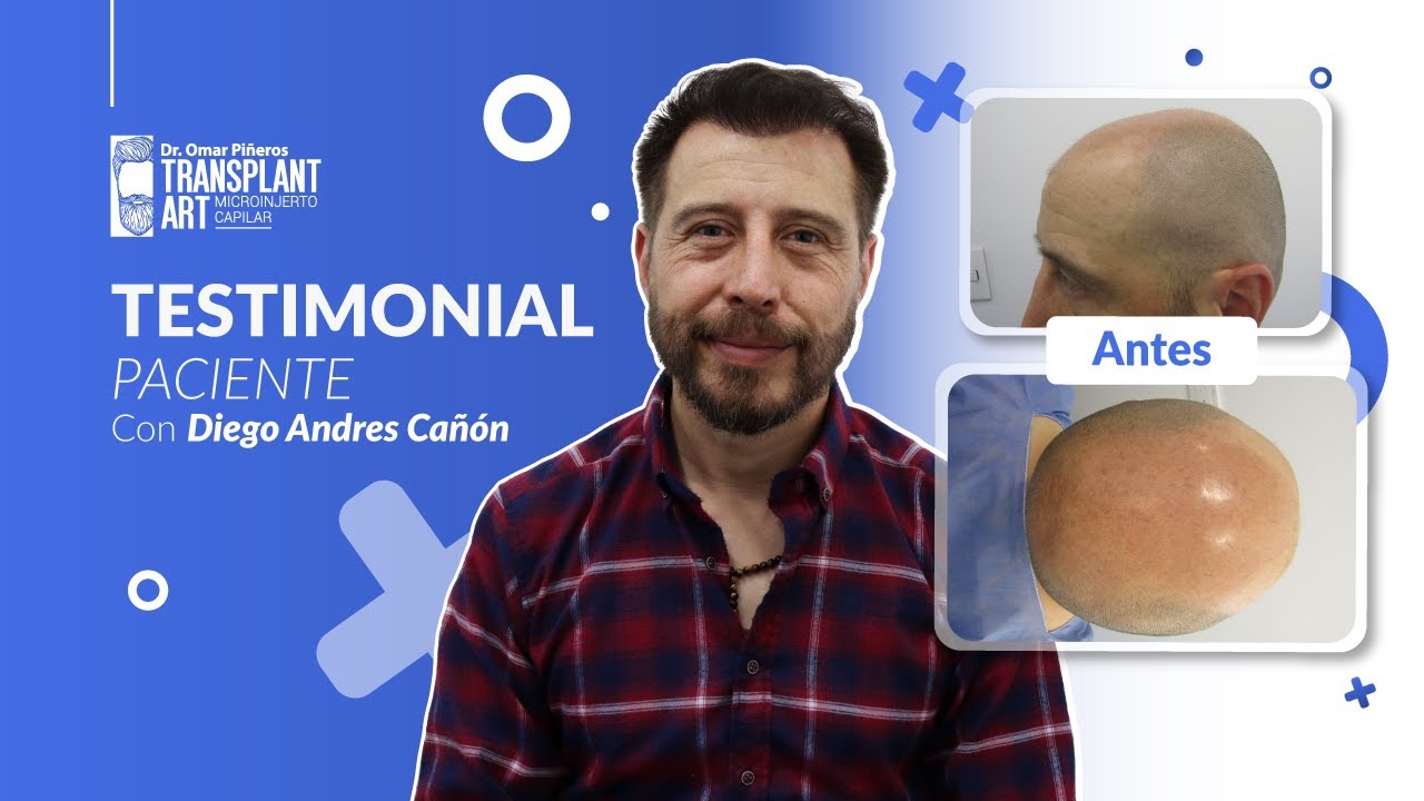 🤯 6 MESES DESPUÉS DEL TRASPLANTE CAPILAR - DIEGO A. CAÑÓN