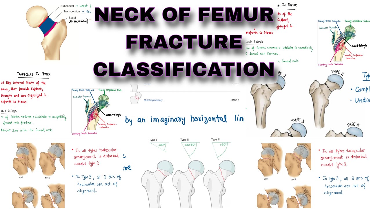 NECK OF FEMUR - Fracture Classification